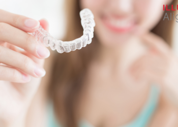 Clear Aligners
