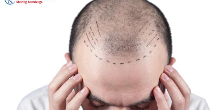 Hair Transplant Market, Size, Industry Trends 2023-2028