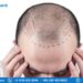 Hair Transplant Market, Size, Industry Trends 2023-2028