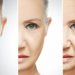 Botox wrinkles Treatment