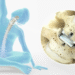 Comparing Titanium and Polymer-Based Artificial Discs: Which Offers Better Flexibility?